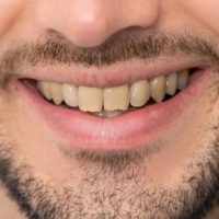 sorriso-antes