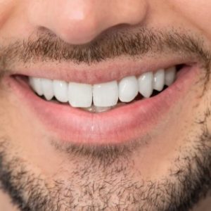 sorriso-depois